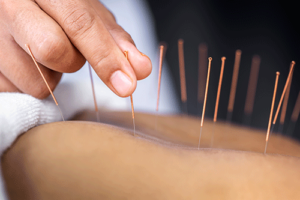 A person experiencing an acupuncture therapy program